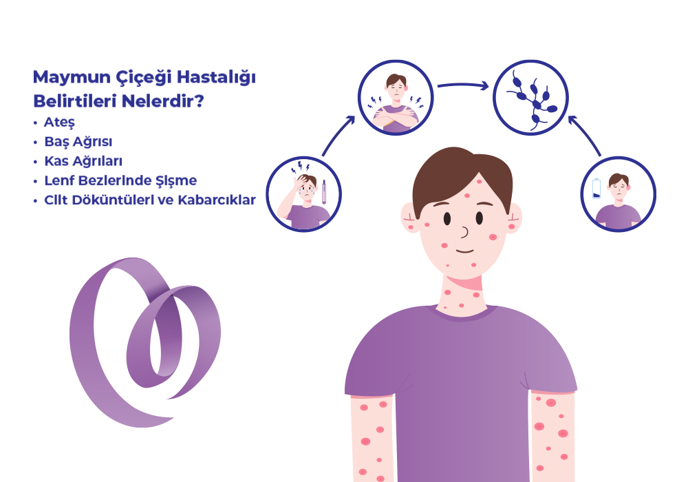 Maymun Çiçeği Hastalığı Belirtileri Nelerdir?