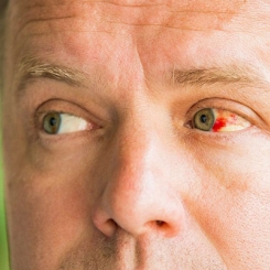 Non Kontakt Tonometre ile Göz Tansiyonu Ölçümü